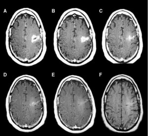 Complete tumor response. (A) Patient 09 at baseline, (B)stable disease atfirst follow-up, (C)partial response (PR) at second follow-up, (D) PR at 20 weeks from start of virotherapy, and (E and F) complete response at 25 and 30 weeks from start of virotherapy