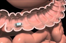 CAMERA PILL MAY MAKE COLONOSCOPIES A THING OF THE PAST