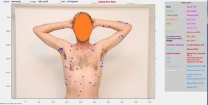 The DermaCompare system identifies and classifies moles and lesions. (Image courtesy of Emerald Medical Applications/Israel21C)