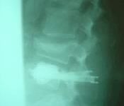 Smart implant will help broken vertebra