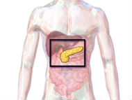New nanomedicine could prevent progression of pancreatic cancer